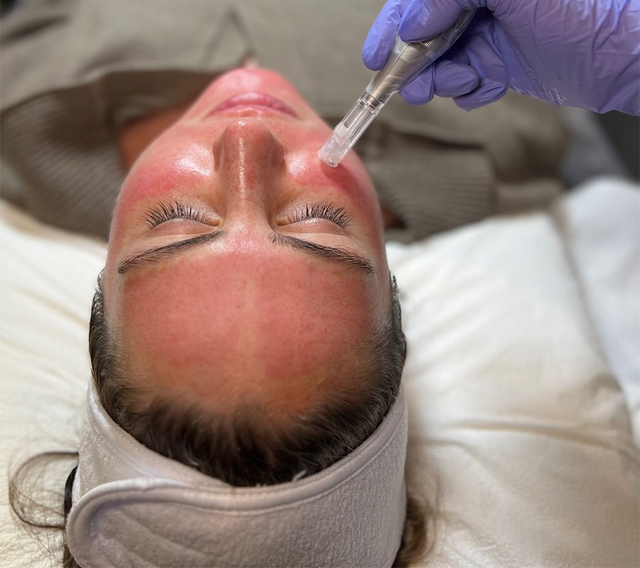 a person laying down and receiving micro-needling treatment